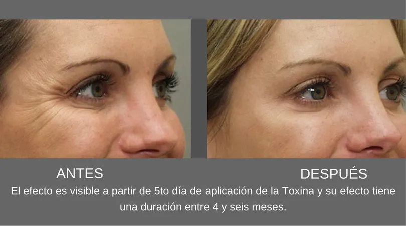 Botox, tan tentador como El Secreto de Dorian Gray.