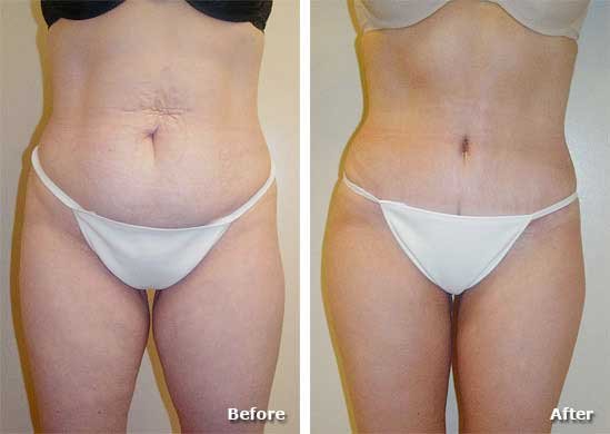 Abdominoplastía por Dr. Manlio Speziale