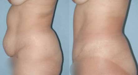 Abdominoplastía por Dr. Manlio Speziale