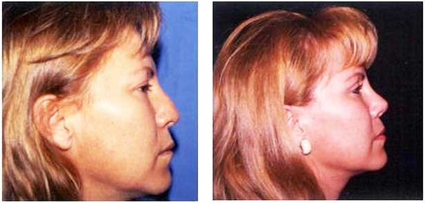 Rinoplastía por Dr. Manlio Speziale
