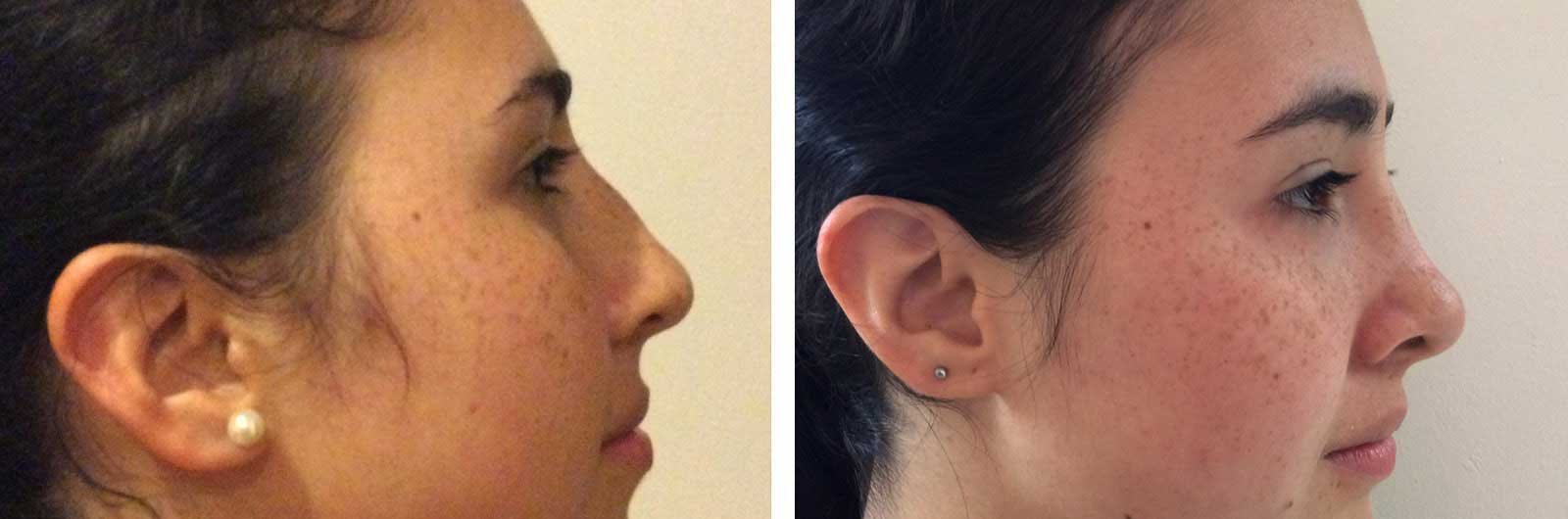 Rinoplastía por Dr. Manlio Speziale
