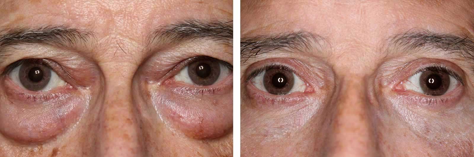 Cirugía de Ojos (Blefaroplastia) | Dr. Manlio Speziale